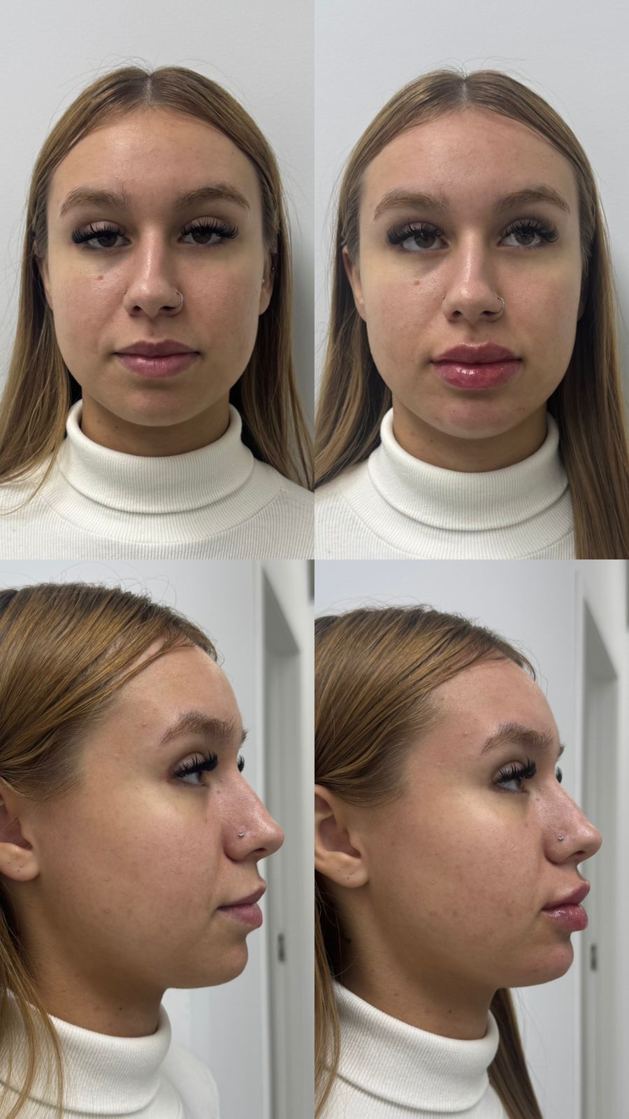 Registro de preenchimento labial realizado na ÉLEVÉ Clinic