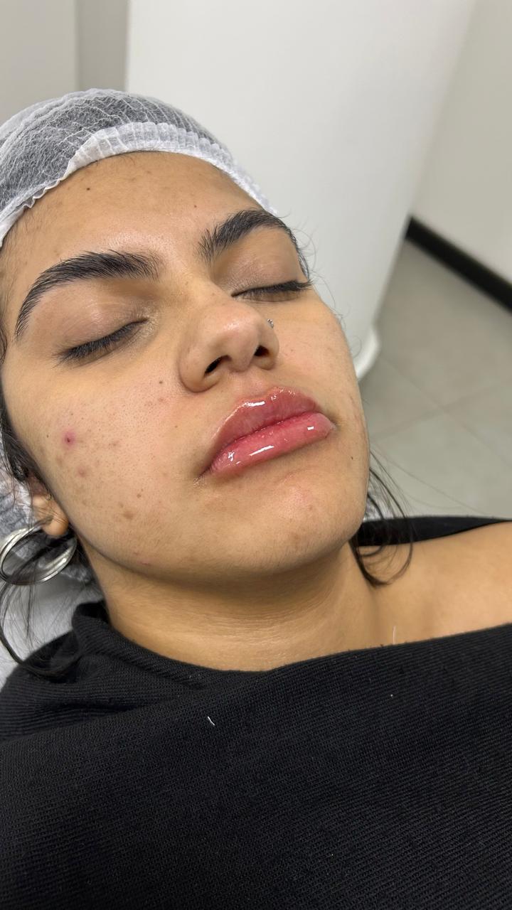 Registro após preenchimento labial na ÉLEVÉ Clinic