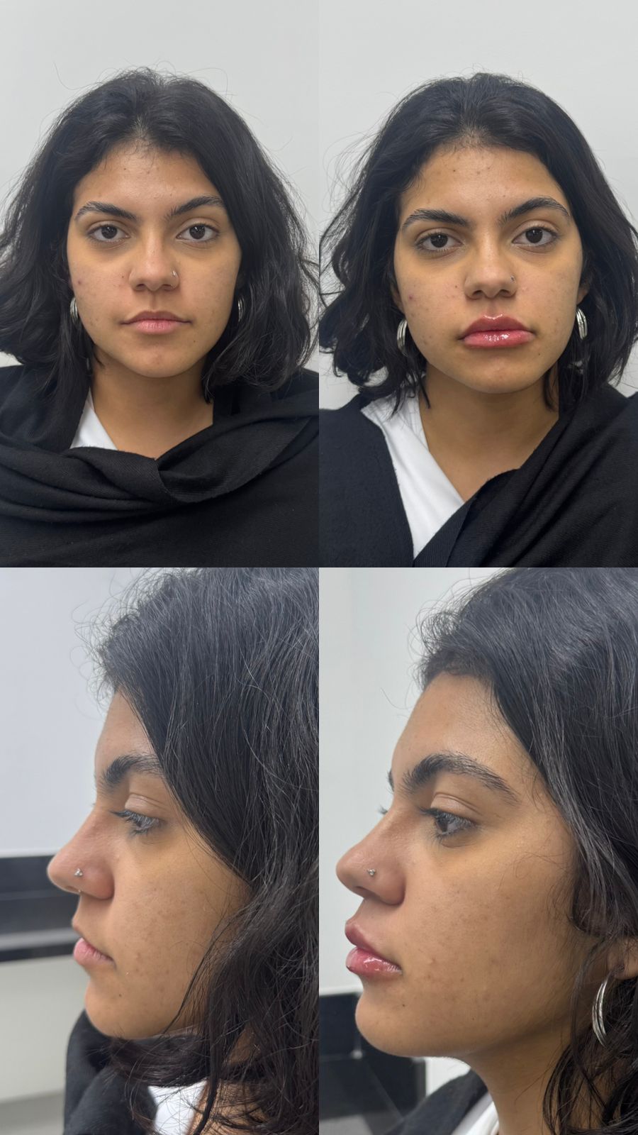 Registro de preenchimento labial em frente e perfil na ÉLEVÉ Clinic
