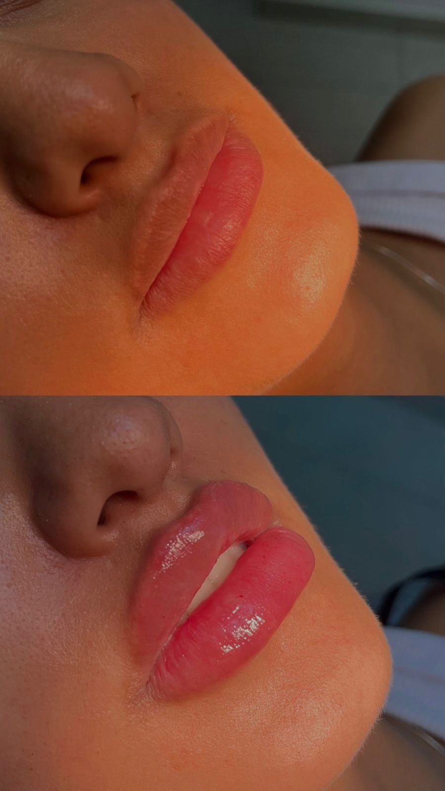 Registro de preenchimento labial antes e depois na ÉLEVÉ Clinic