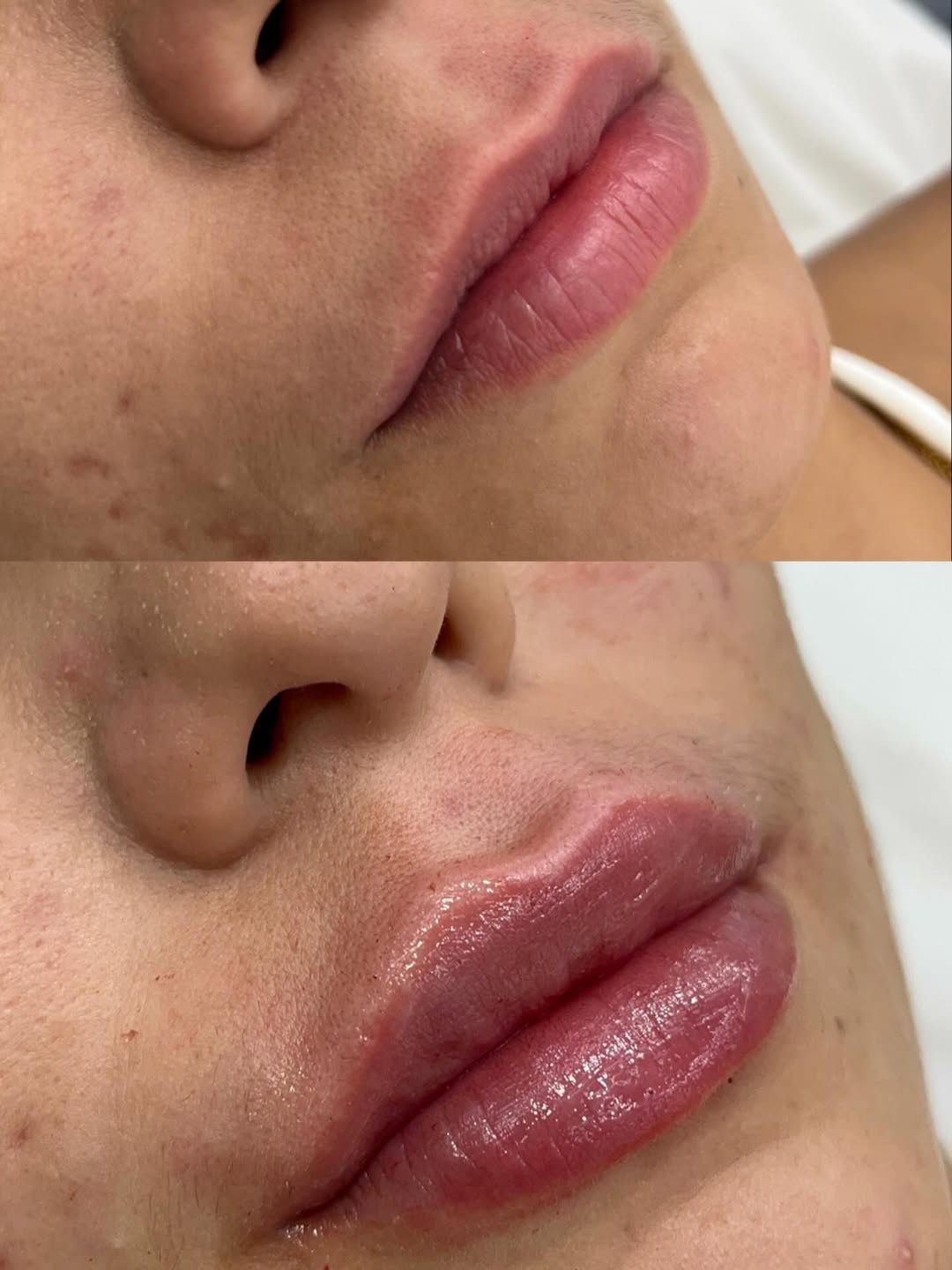 Registro de preenchimento labial antes e depois em perfil na ÉLEVÉ Clinic