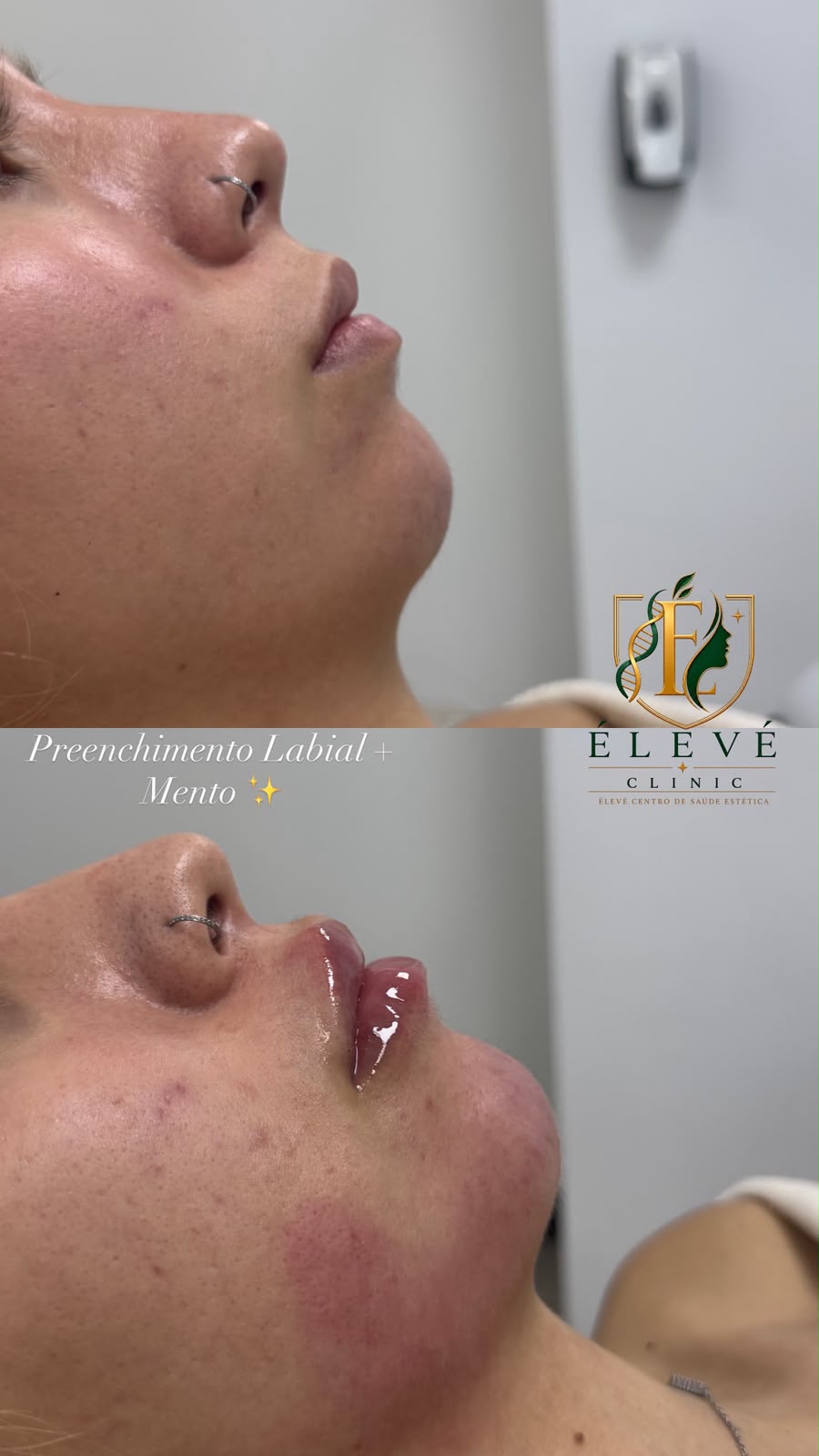 Registro de preenchimento labial e mento na ÉLEVÉ Clinic